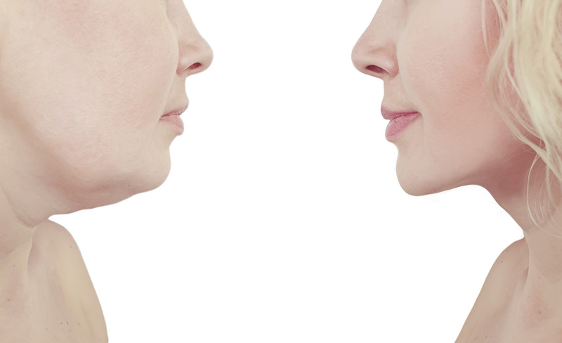 dermal fillers fairfax va