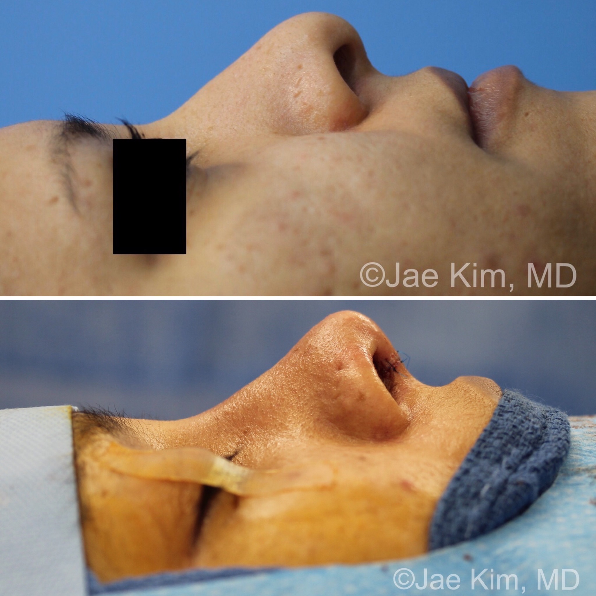 Austin Rhinoplasty Surgery