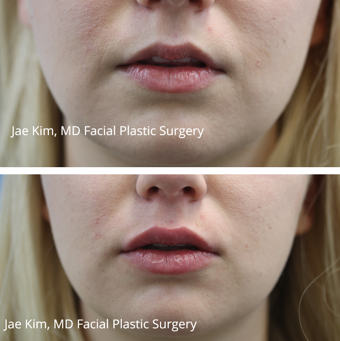 lip injections fairfax va