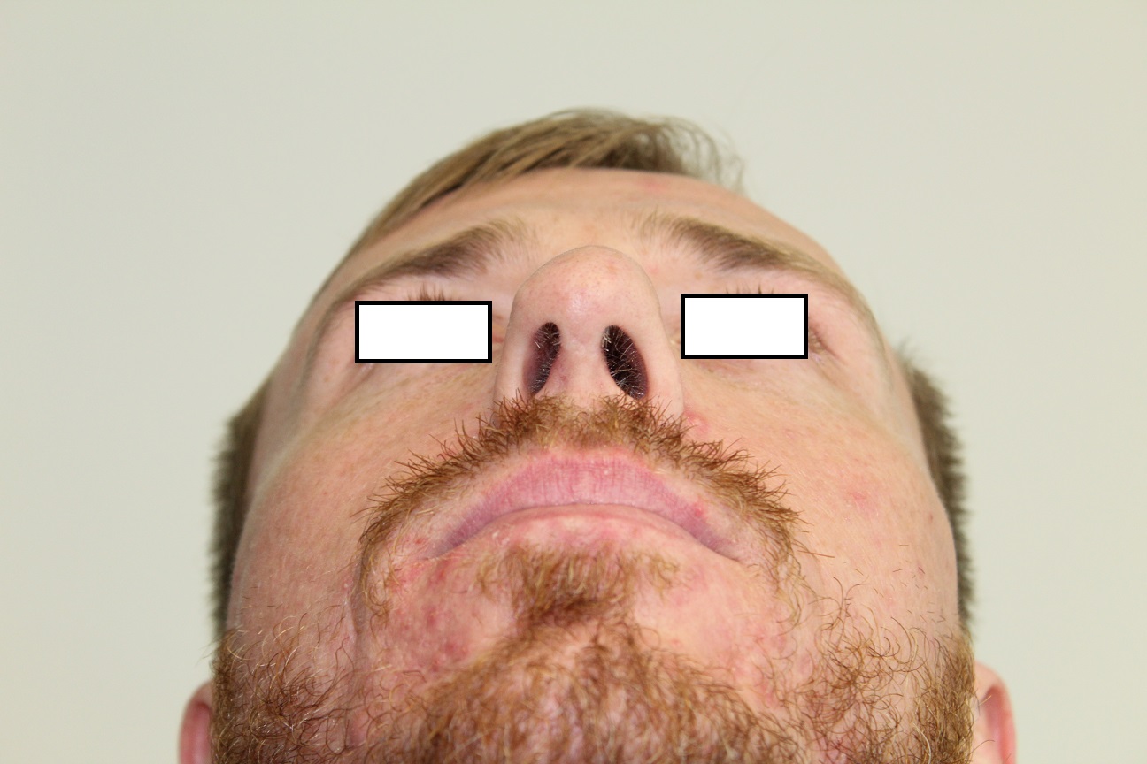 World Class Rhinoplasty Fairfax VA Nose Job Surgery Specialist AFTER 22 