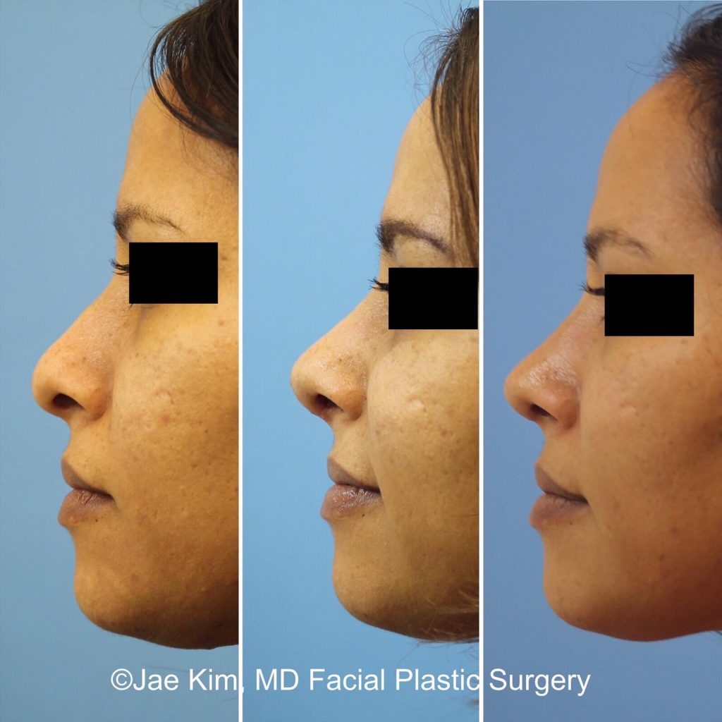 rhinoplasty nose job fairfax va