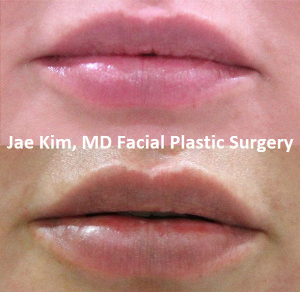 lip fillers Fairfax VA