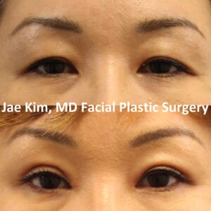 What to Expect at Your Asian Eyelid Consultation