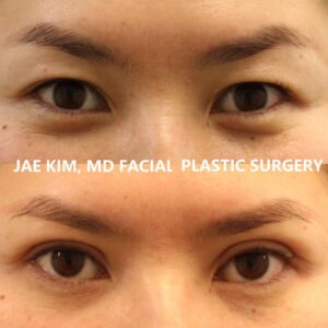 Asian eyelid surgery recovery