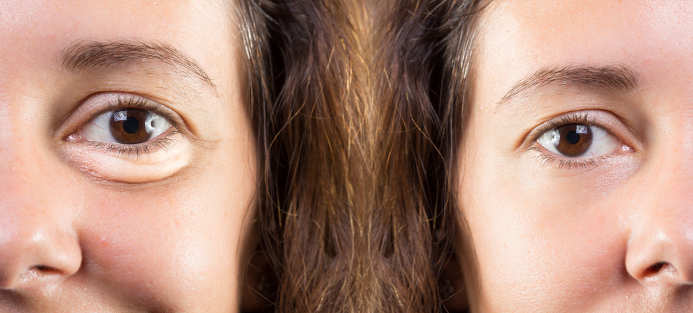 How Much Does Eyelid Surgery Cost in Tysons Corner?
