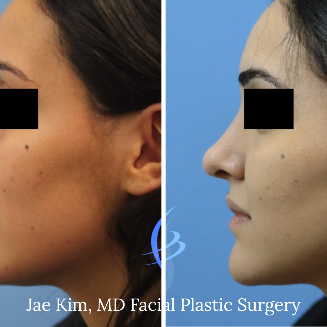 World Class Rhinoplasty Fairfax VA Nose Job Surgery Specialist Botros Side 1 1300x1300 