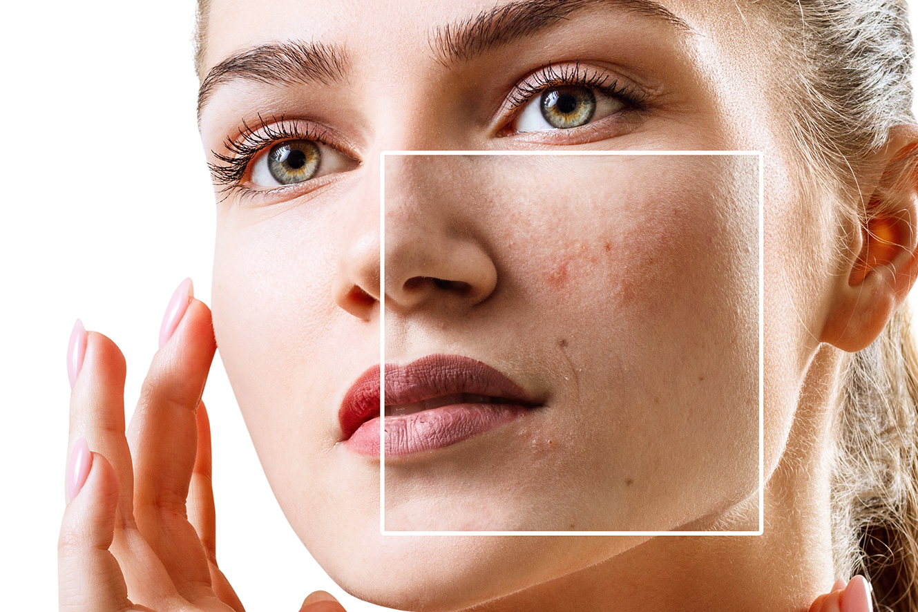 Dark spots clearance on face