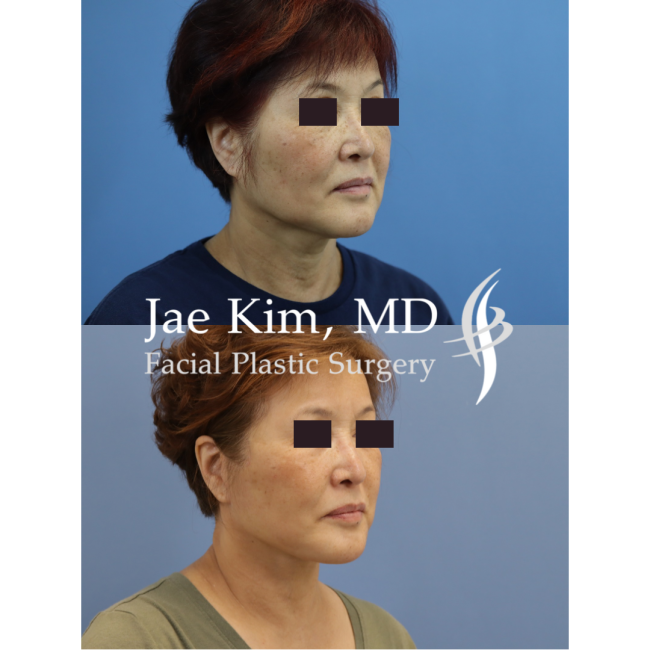 Face and Neck Lift - Jae Kim, MD