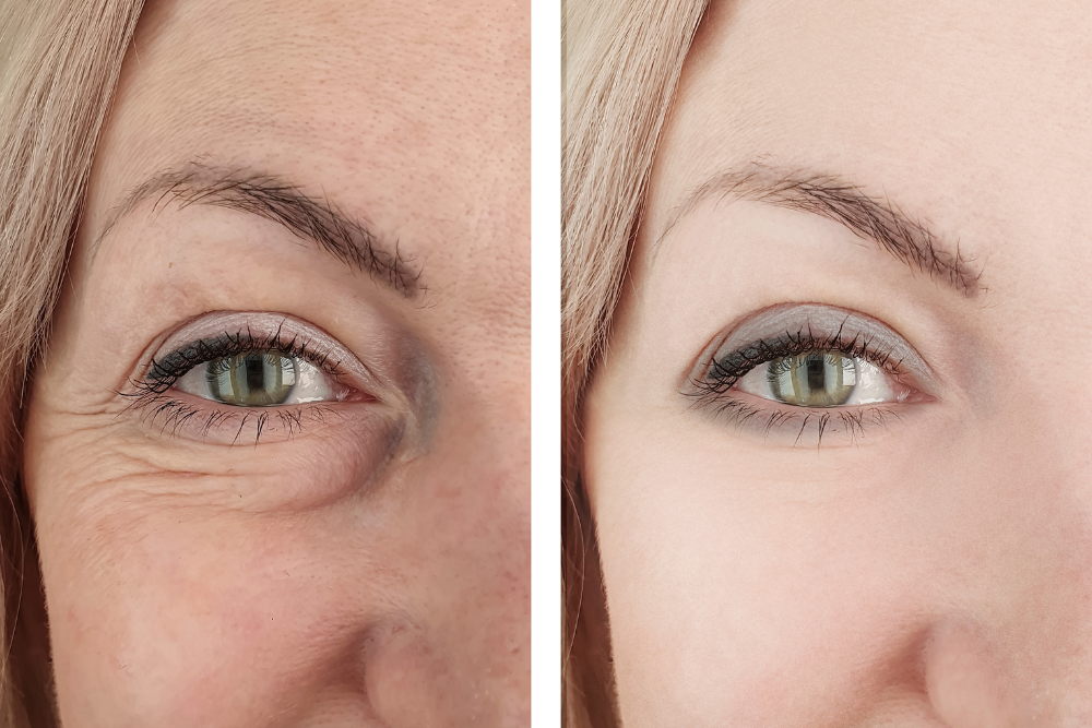 Expert Eyelid Rejuvenation in Alexandria, Virginia