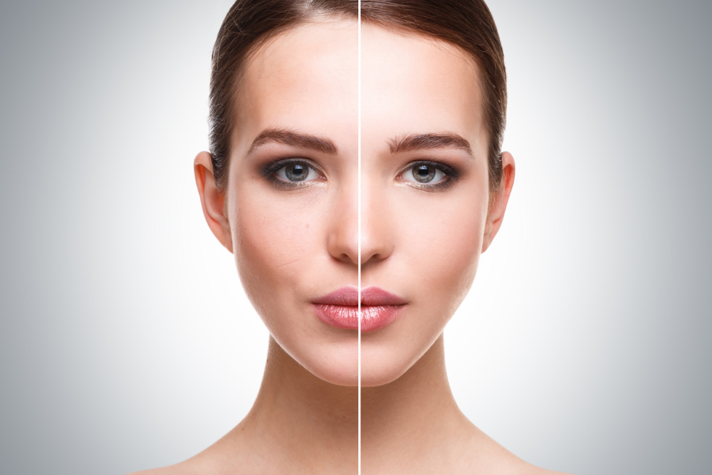 Restore Volume With Expert Dermal Fillers in Springfield, Virginia