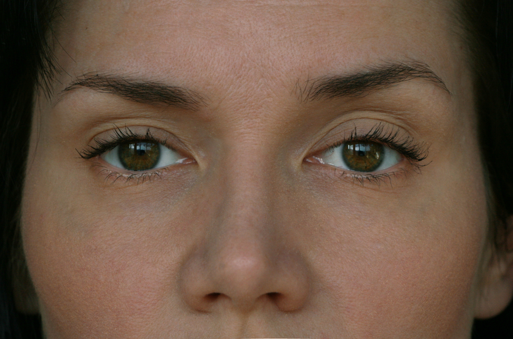 Upper Eyelid Lift Surgery Pricing Guide for 2025: What You Need to Know