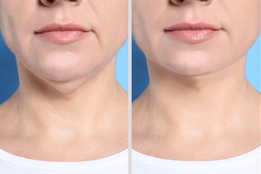 Radiofrequency Skin Tightening and Facial Firming in Tysons, VA