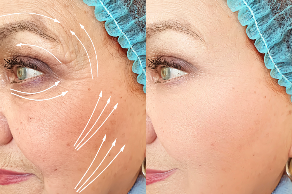 Full Eyelid Lift Surgery Appointments and Recovery Expectations in McLean, VA