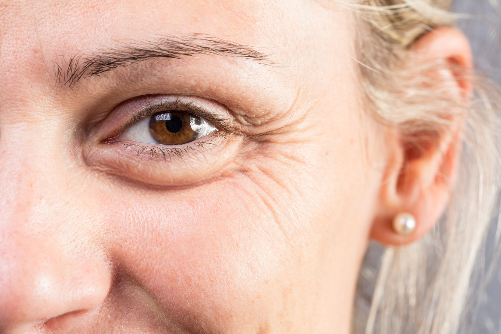 Lower Eyelid Surgery for Bags and Puffiness in Fairfax, VA