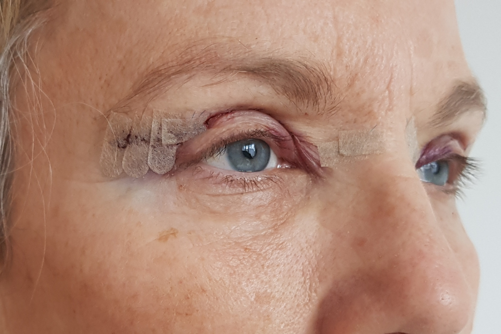 Eyelid Rejuvenation Techniques in Vienna, Virginia