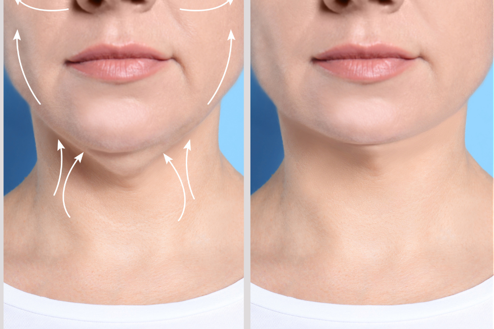 Best Surgeon for Neck Lift Surgery in McLean, VA
