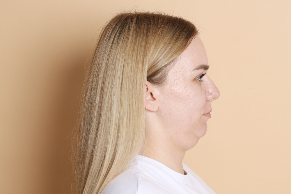 Chin Augmentation Surgery in Arlington, VA