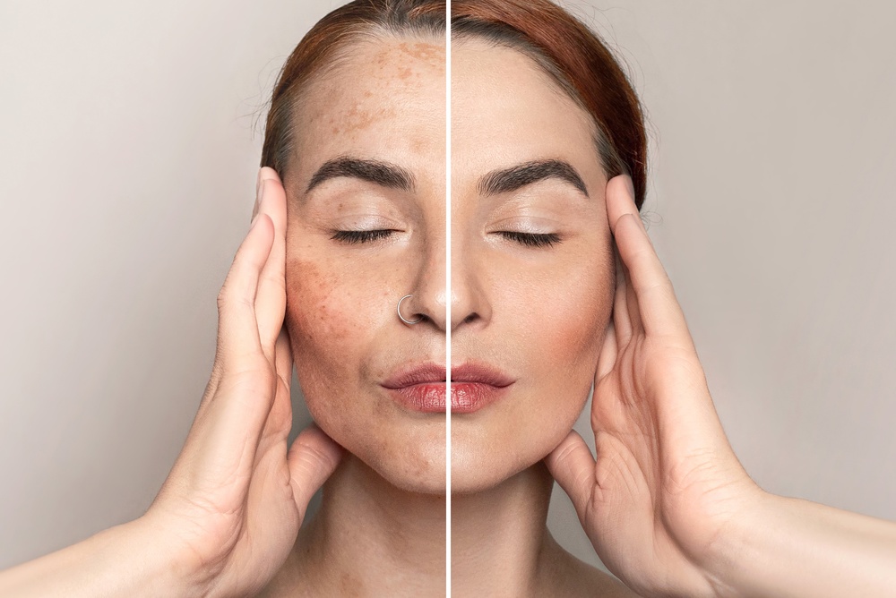 Dermamelan® Pigment Correction Program