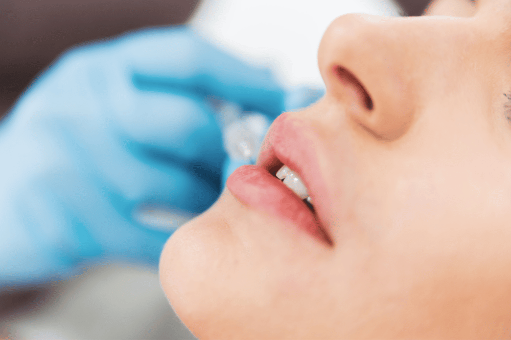 Affordable Lip Filler Appointments in McLean VA