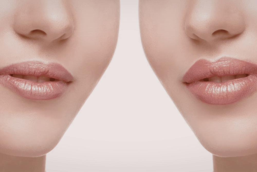 Lip filler in Fairfax VA