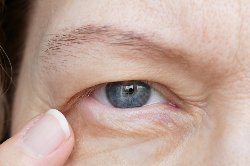 Expert Eyelid Surgeon in Virginia: Cosmetic Blepharoplasty and Natural Results
