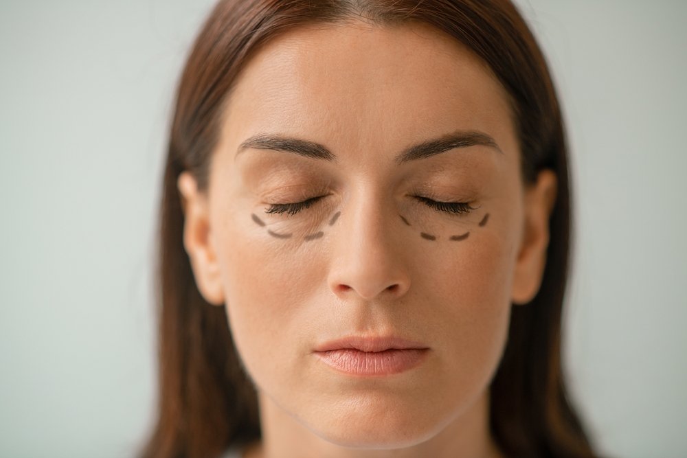 Leading Revision Eyelid Surgeon in Virginia for Corrective Blepharoplasty