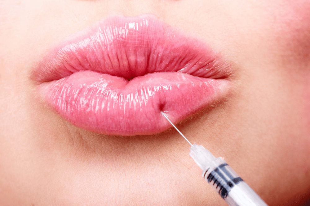 Lip Filler in Tysons VA