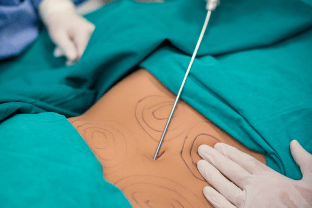 Liposuction Prices in McLean VA