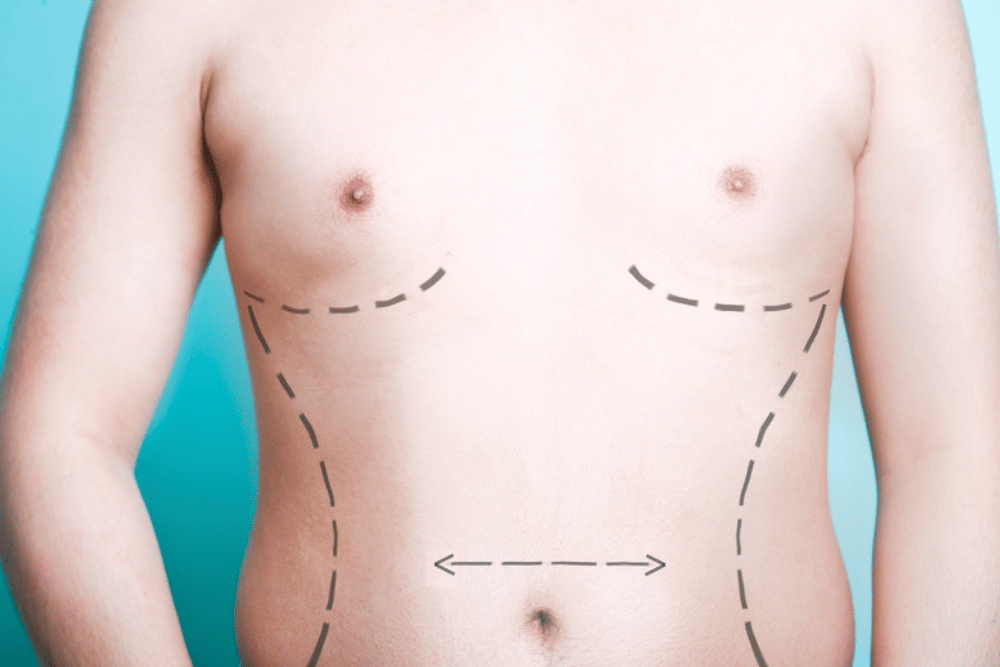 Liposuction Surgeon in Fairfax VA