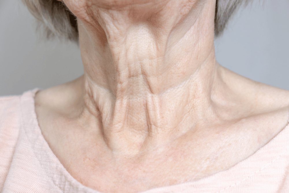 Neck Lift Surgery in Tysons VA