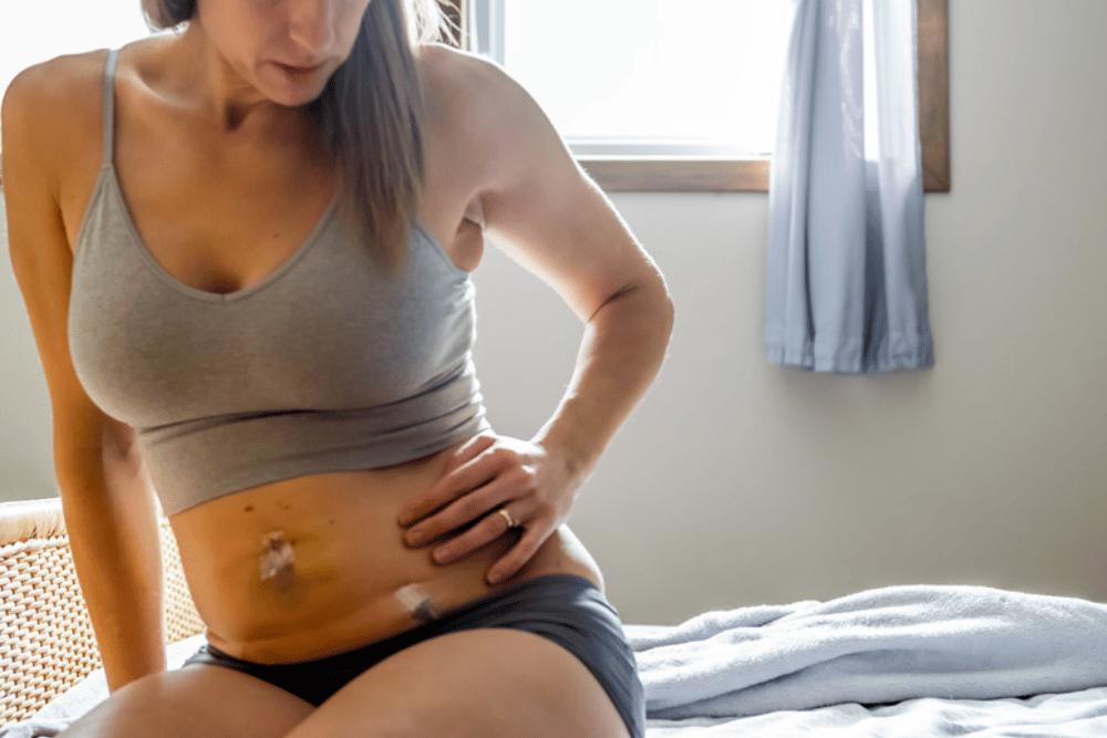 Tummy Tuck in Vienna VA